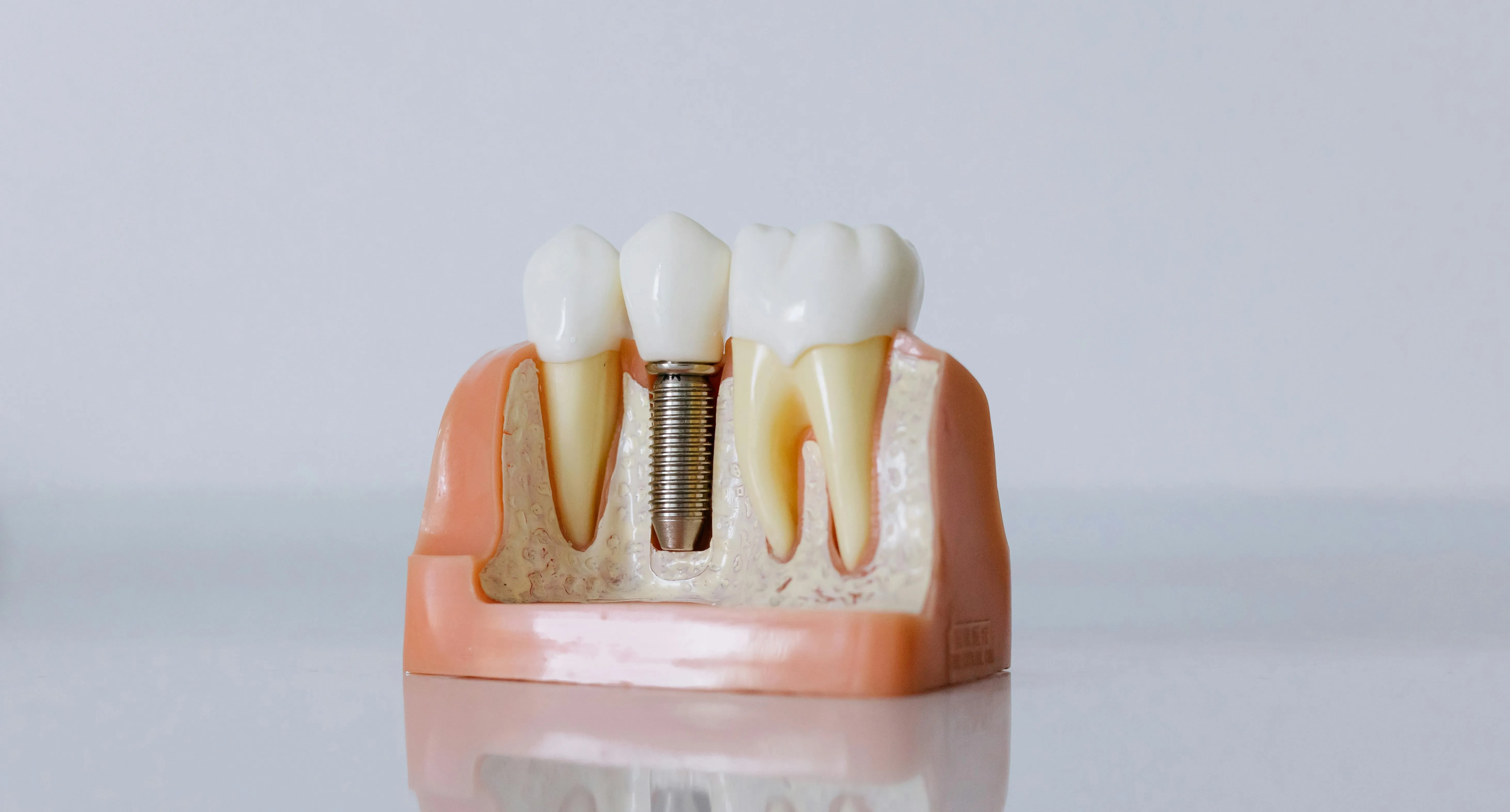 Çene kesiti modeli: ortadaki dişin yerinde, kemiğin içine yerleşmiş vidalı implant; iki yanında kökleriyle duran doğal dişler.